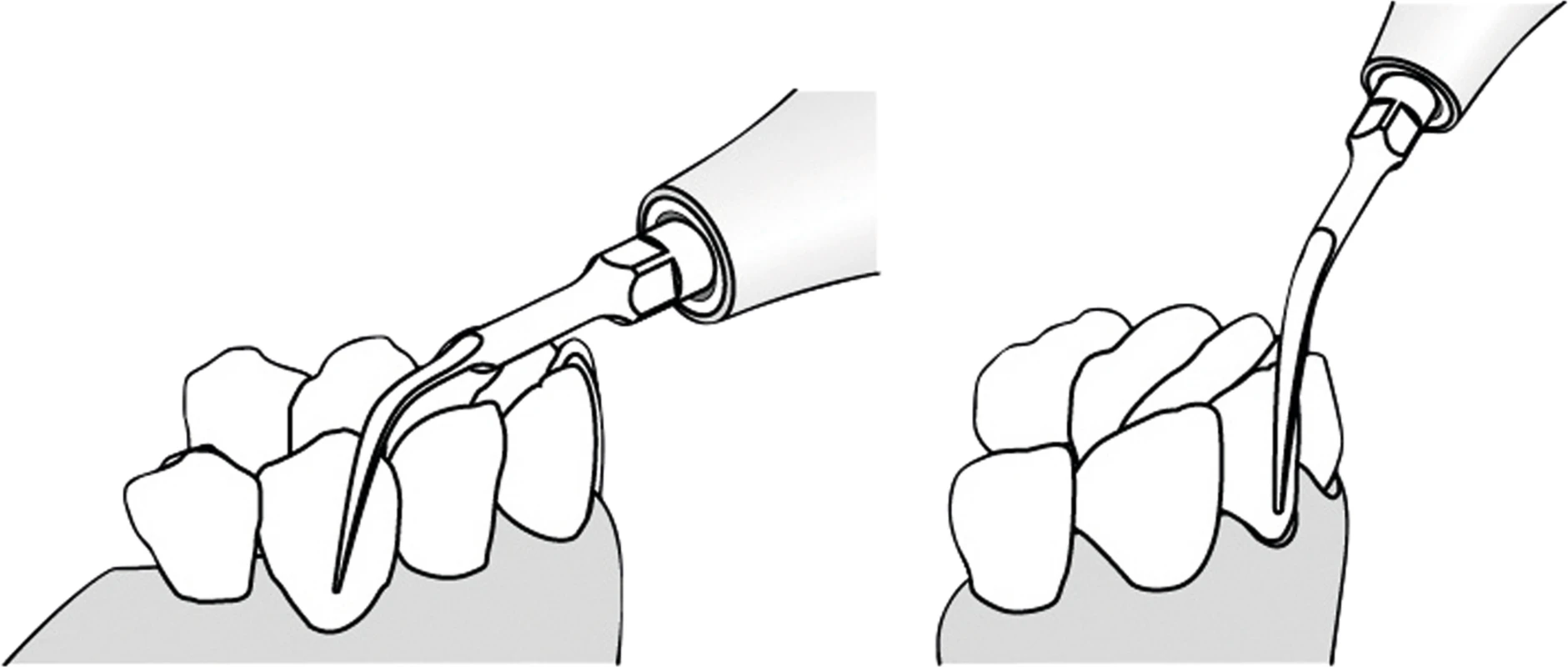 PIEZO Scaler Tip Satz