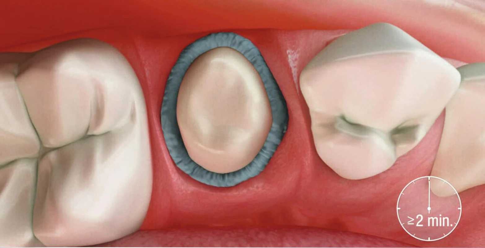 Adstringierende Retraktionspaste 3M
