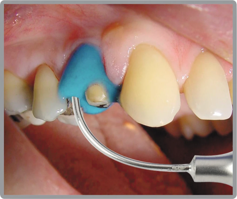 ALGILOID® Packung 48 Zylinderampullen