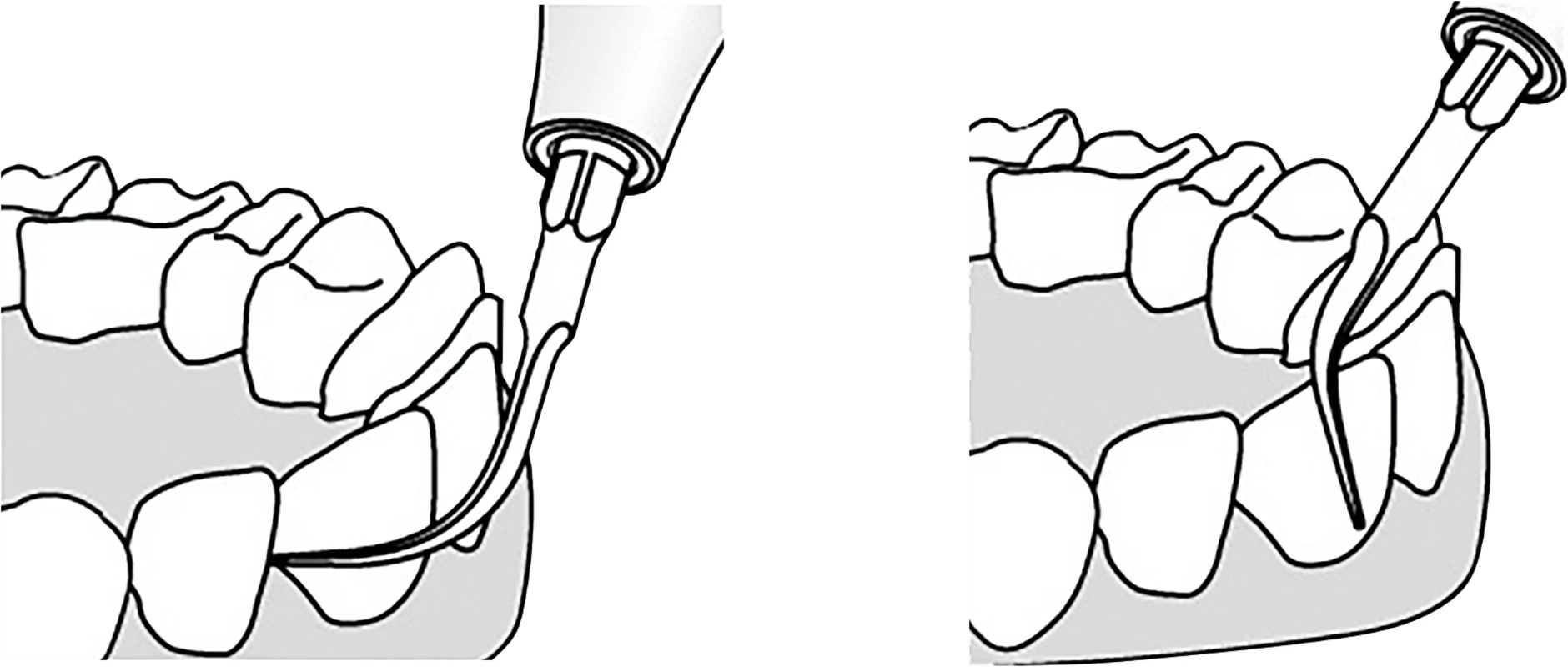 PIEZO Scaler Tip Satz