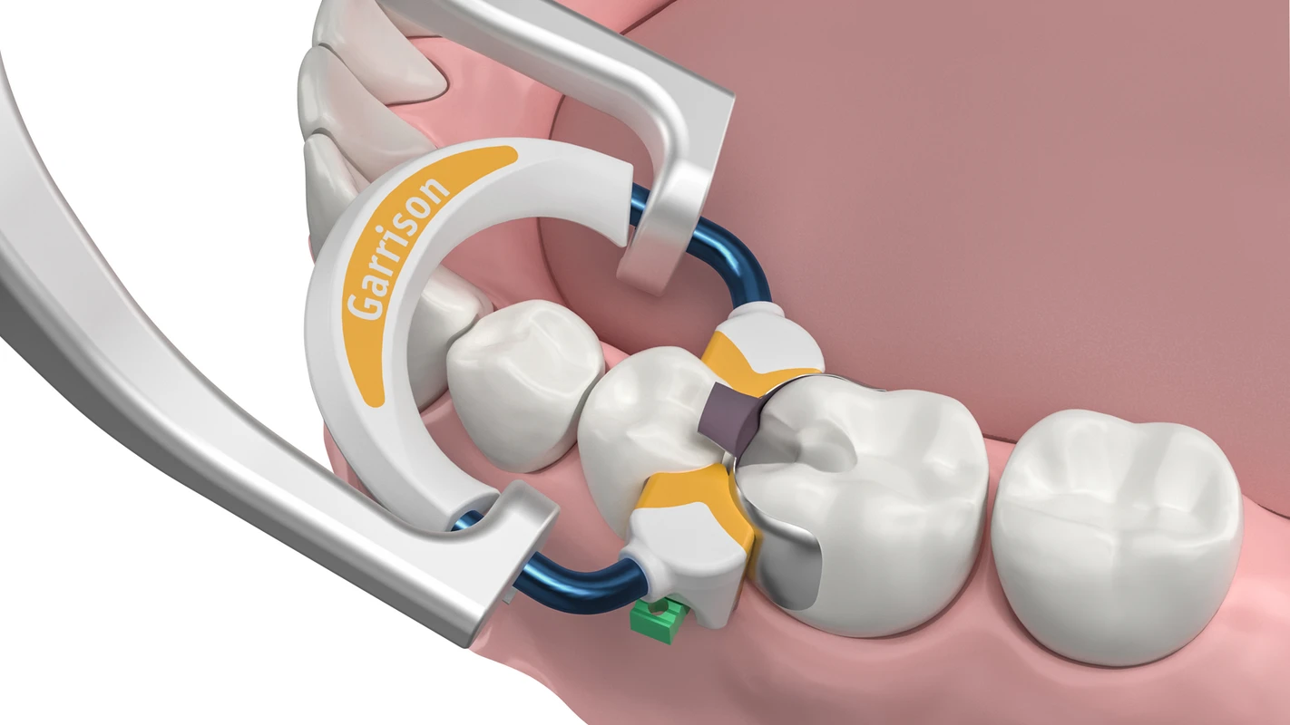 Strata-G™ Teilmatrizen-Ringe Garrison Dental Solutions