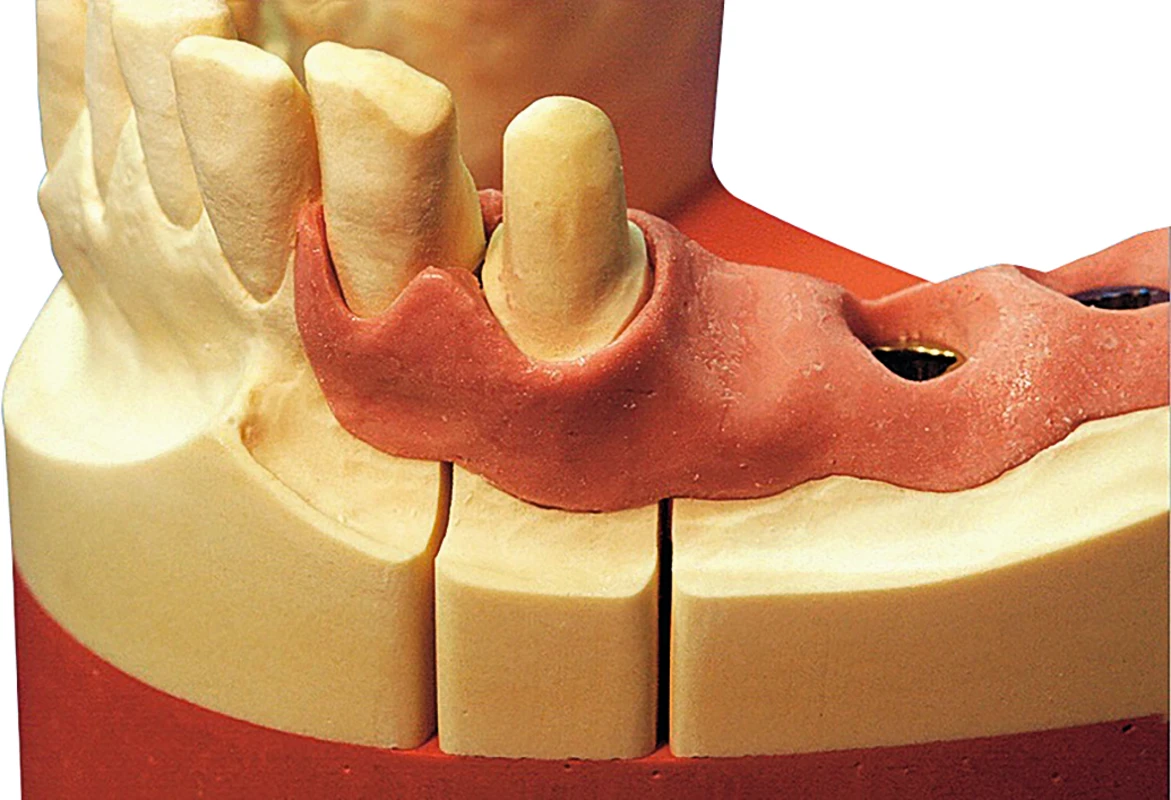 Majesthetik-Gingiimplant Set 2 x 50 ml Doppelkartusche, 12 Mischkanülen