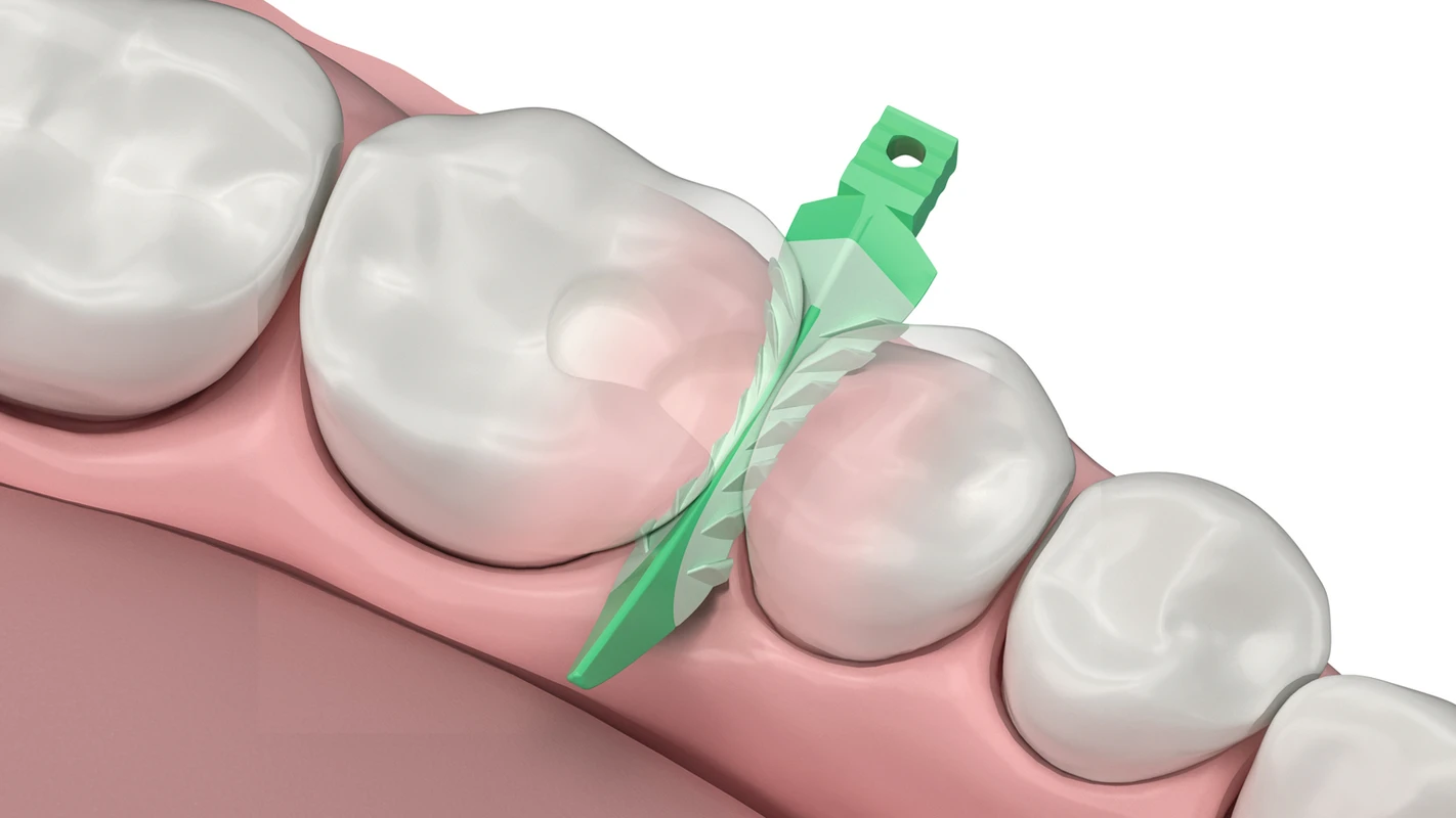 Strata-G™ Teilmatrizen-Keile Nachfüllpackung 100 Stück groß, grün