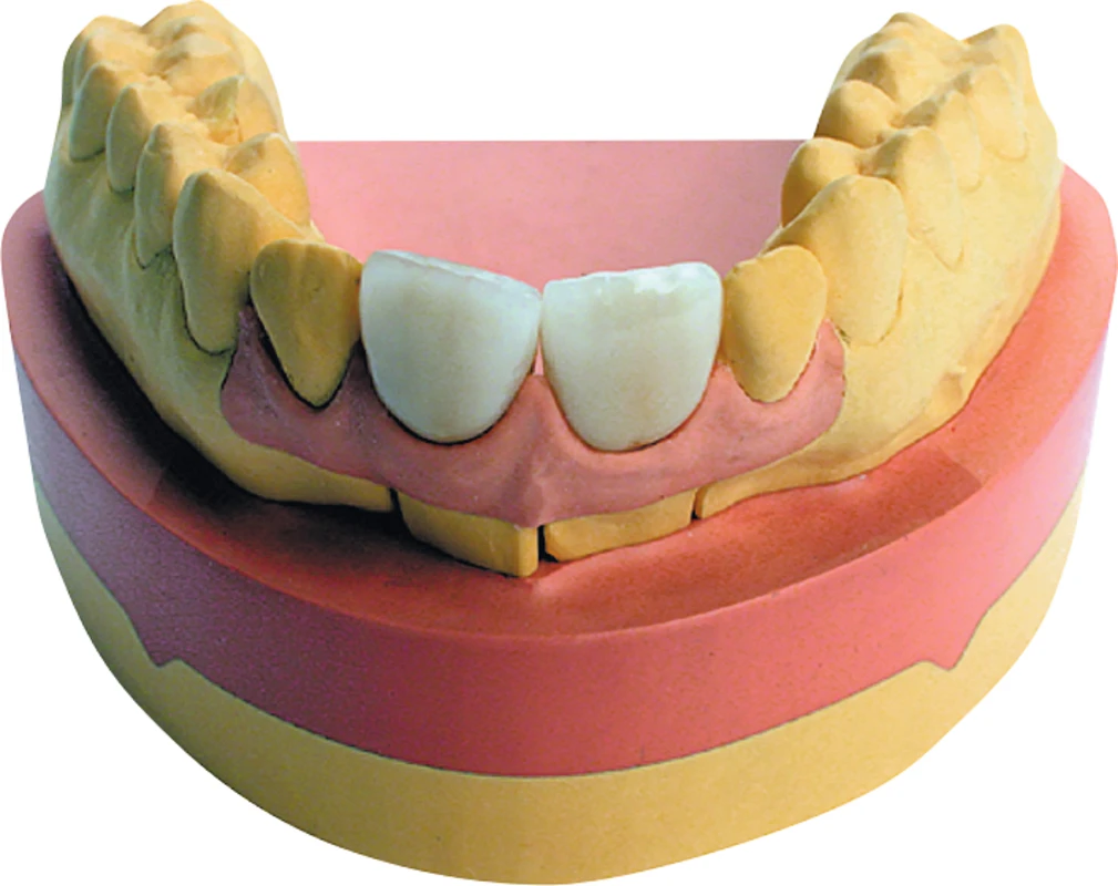Majesthetik® -Gingiva Set