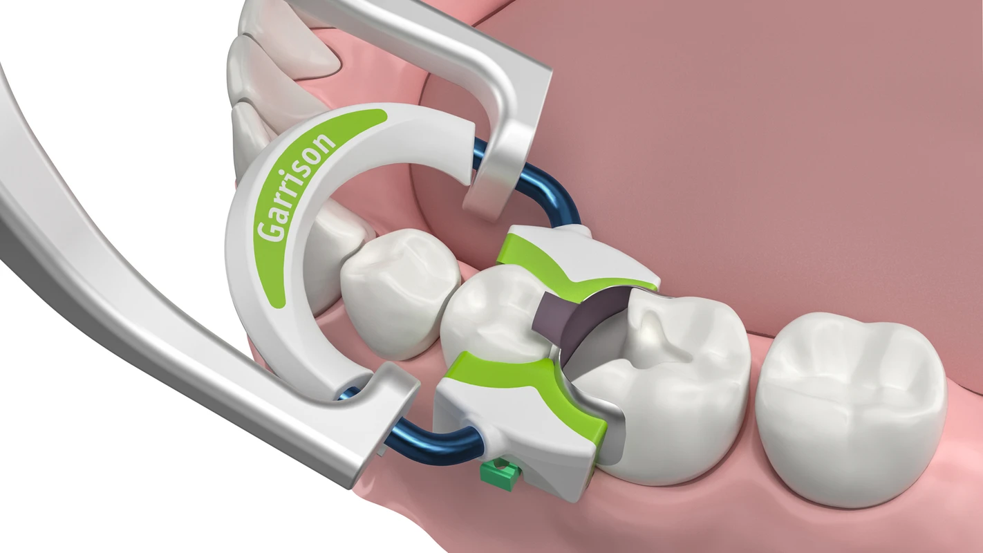 Strata-G™ Teilmatrizen-Ringe Garrison Dental Solutions