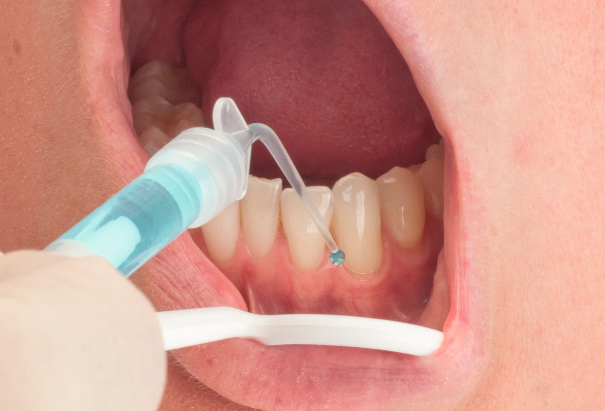MIRAJECT® FLEXI TIP Packung 25 Einmalkanülen 21G